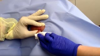 Abscess Drainage Performed by Dermatologist Dr David Myers [upl. by Hilar216]