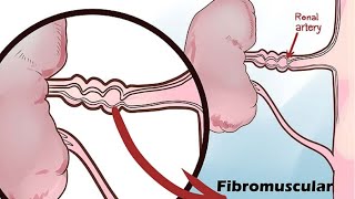 Renal Artery Stenosis [upl. by Hogen]