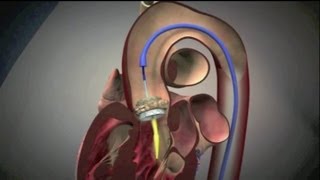 Inicio de Aterosclerosis Aterogenesis [upl. by Esdras959]