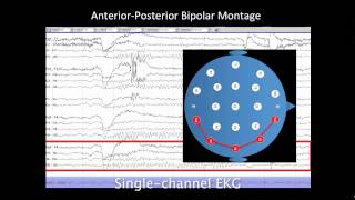 Introduction to EEG [upl. by Anitsud781]