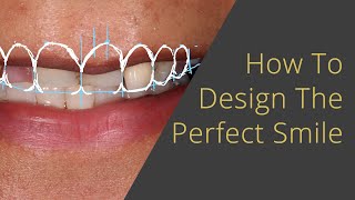 Designing the Perfect Veneers or All on 4 Smile [upl. by Navlys168]