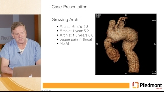 Echocardiogram Suprasternal View Aortic Arch Color Flow [upl. by Nauj]