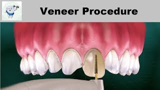 Dental Veneers Procedure Step by step [upl. by Samohtnhoj]