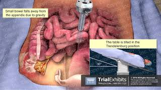 Laparoscopic Appendectomy [upl. by Kameko]