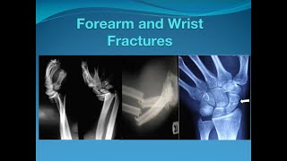 Forearm and Wrist fractures [upl. by Anitan]