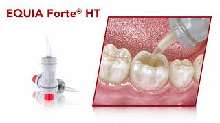 EQUIA Forte® HT  Restoration Guide [upl. by Ardyce851]