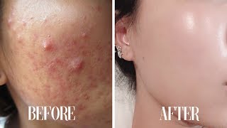 Get CLEAR SKIN subliminal  Get rid of acne in 10 minutes [upl. by Morissa]