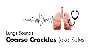 Coarse Crackles Rales  Lung Sounds  Medzcool [upl. by Naujid]