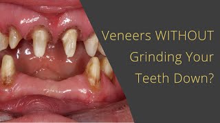 Dental Veneers Without Grinding Your Teeth Away [upl. by Odlanyar]