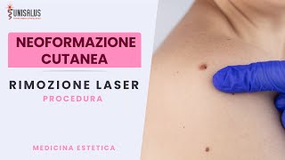 Rimozione laser neoformazione cutanea [upl. by Pauiie]