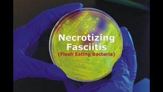 Necrotizing Fasciitis  Flesh Eating Bacteria [upl. by Rellia]