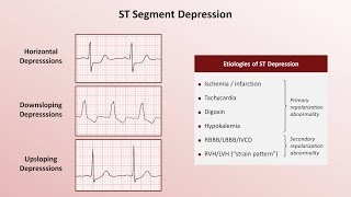 Intro to EKG Interpretation  QRST Changes [upl. by Adnoval]