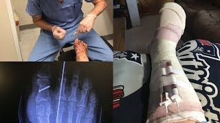 BUNION SURGERY RECOVERY AND PAIN MANAGEMENT FIRST 5 WEEKS [upl. by Lrad]