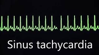 Cardiovascular System 8 Normal and abnormal heart rhythms [upl. by Groves]