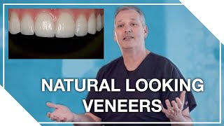 Natural Looking Veneers Dr Creasman [upl. by Abrams645]