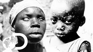 The Eradication Of Smallpox  Invisible Killers [upl. by Alaster]