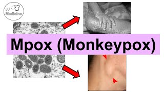 Mpox Monkeypox  Transmission Pathophysiology Signs amp Symptoms Diagnosis Treatment [upl. by Yemerej]