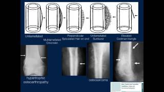 Bone Lesions Radiographic Assessment Part 1 by Geoffrey Riley MD [upl. by Euqirdor]