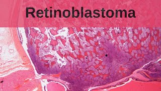 Retinoblastoma  Pathology mini tutorial [upl. by Llednek]