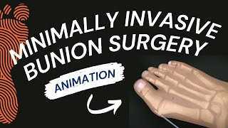 Minimally Invasive Bunion Surgery A Short Animation [upl. by Zingg]