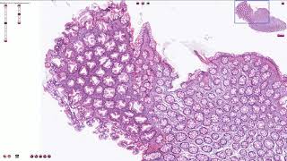 Hyperplastic Polyp  Colon  Histopathology [upl. by Lamarre]