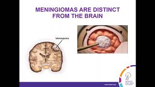 WEBINAR Treatment Strategies for Meningioma [upl. by Mireielle]