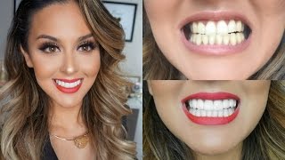 My Teeth Transformation l Veneers Experience [upl. by Salzhauer]