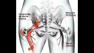 Liberação Miofascial Glúteo Médio Minimo e Tensor da Fáscia Lata  Fisioterapia Dr Robson Sitta [upl. by Leoine]