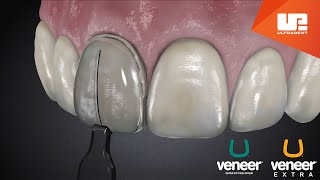 Uveneer® Procedure Animation  Direct Veneer Template System [upl. by Petunia]