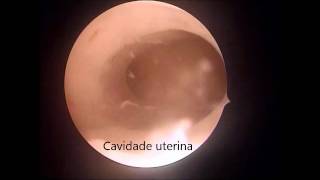 Histeroscopia Diagnóstica Como é o exame  Passo a passo [upl. by Werdma]
