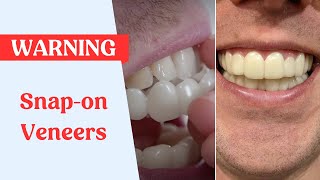 Snap On Veneers Warning [upl. by Enirroc]