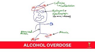 Acute Alcohol Intoxication [upl. by Maurizia]