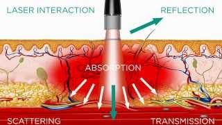 High Intensity Laser  Medical Effects [upl. by Leontina]