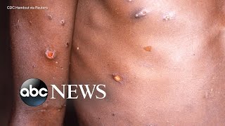 The symptoms treatment for monkeypox l ABC News [upl. by Breed]