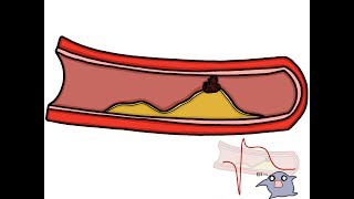 What is Coronary Artery Disease  Mechanism of Disease [upl. by Ahswat]