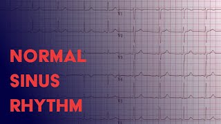 Normal Sinus Rhythm  EKG ECG Interpretation [upl. by Adnac]