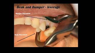 Physics Forceps Atraumatic Extraction Technique  GoldenDent [upl. by Leunammi171]