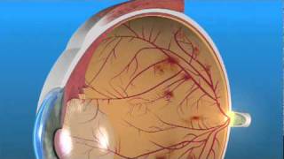 Diabetic Retinopathy  Ophthalmology [upl. by Callista510]