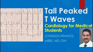 Tall Peaked T Waves  Cardiology for Medical Students [upl. by Ahsercal]