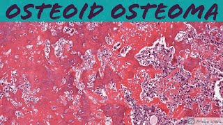 Osteoid Osteoma Bone Pathology Basics [upl. by Kling]