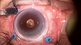 Macular Pucker Surgery [upl. by Javed200]