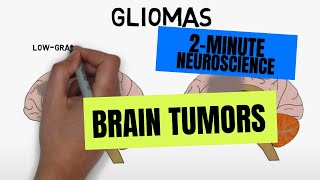 Doctor Explains Glioma Brain Tumor [upl. by Sheehan]