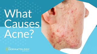 What Causes Acne  Explained by Dermatologist [upl. by Raycher167]