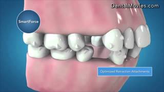 Invisalign G6 Clinical Innovations for First Premolars Extraction [upl. by Geiger]