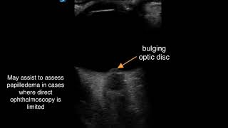 POCUS to Identify Papilledema [upl. by Jerman]