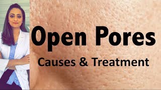 Open Pores Causes amp Treatment  Dermatologists opinion  Dr Aanchal Panth [upl. by Froma]