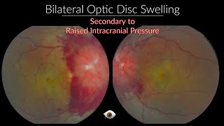 Papilloedema  Optic Nerve swelling [upl. by Rexana698]