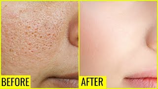 How to Get Rid of Large OPEN PORES Permanently  Anaysa [upl. by Laamak]