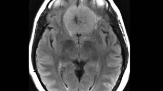 Meningioma Planum Sphenoidale [upl. by Amahs]