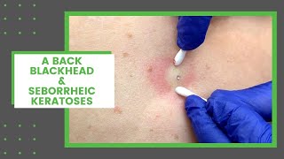 A Back Blackhead amp Seborrheic Keratoses  Dr Derm [upl. by Betthezul]